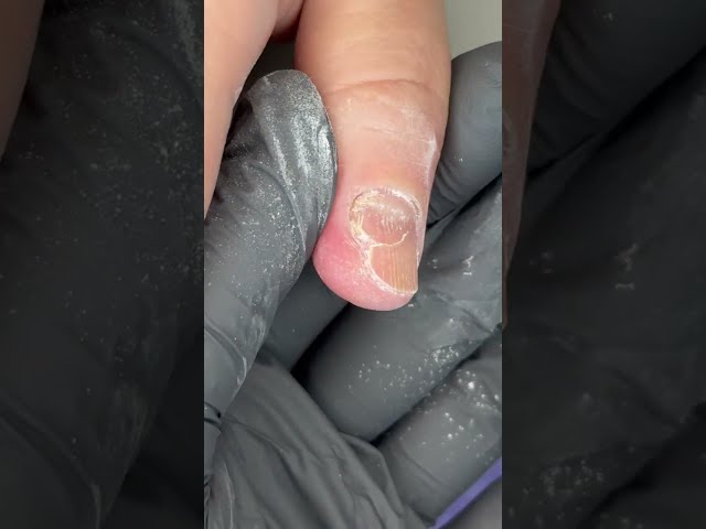 Her Nail is Lifting OFF due to TRAUMA🥵