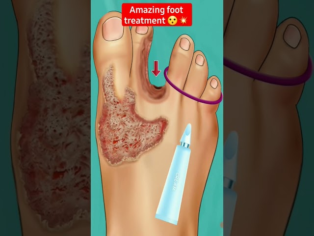 Foot treatment 😮💥 #shorts #asmr #treatment #viral #games