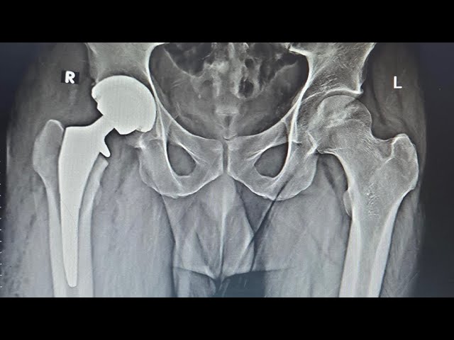 Direct Anterior Hip Replacement-Benefits, Risks & who it’s meant for ! Live show with Q&A 01.02.2026