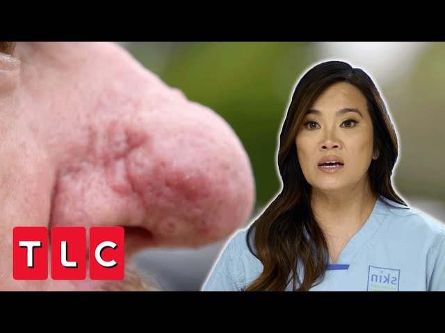 Dr Lee Reconstructs A Nose With Rhinophyma | Dr Pimple Popper Pop Up | CENSORED