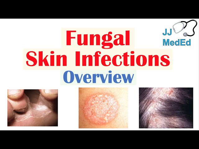Overview of Fungal Skin Infections | Tinea Infections
