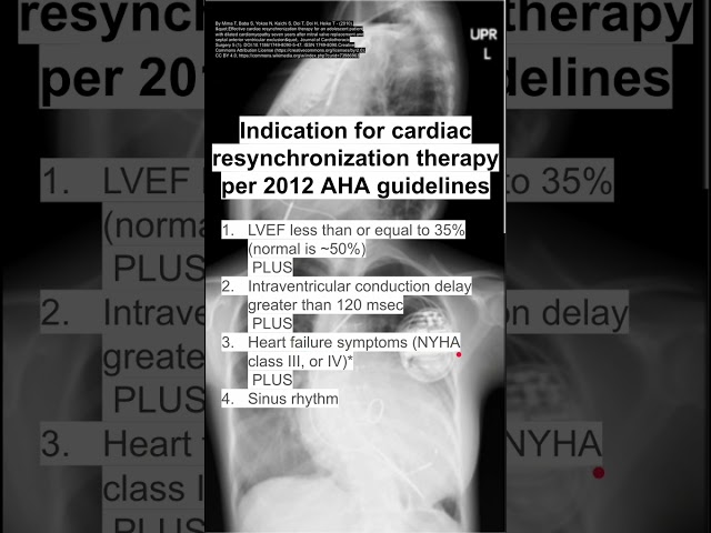 Indication for cardiac resynchronization therapy per 2012 AHA guidelines