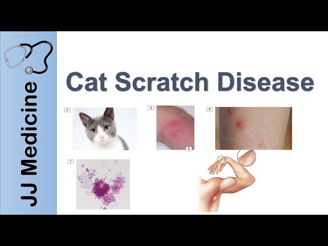 Cat Scratch Disease | Causes, Symptoms and Treatment