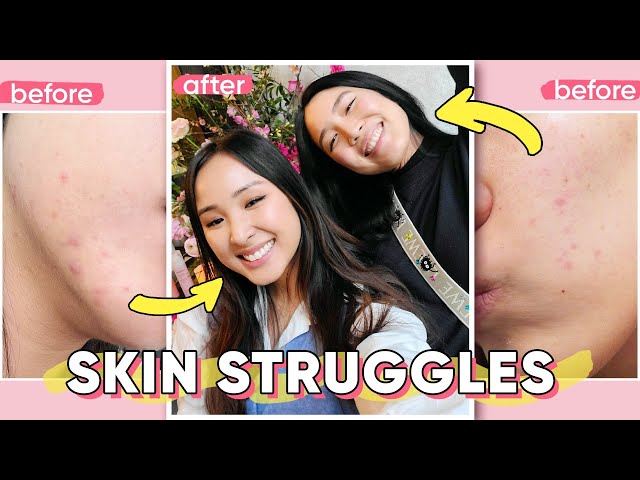 Dealing With Acne & Eczema | Skincare & Self Love Chats