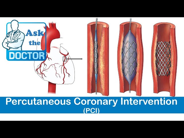 Percutaneous Coronary Intervention (PCI)