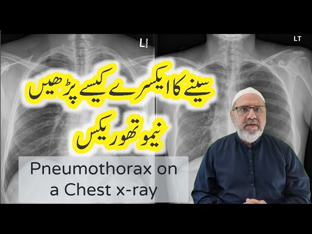 Pneumothorax on a Chest x ray || Chest x-ray interpretation in Urdu || Hindi