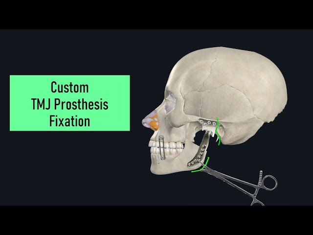 Surgery: Custom TMJ Prosthesis Fixation (Stryker TMJ Concepts) [401-P6]