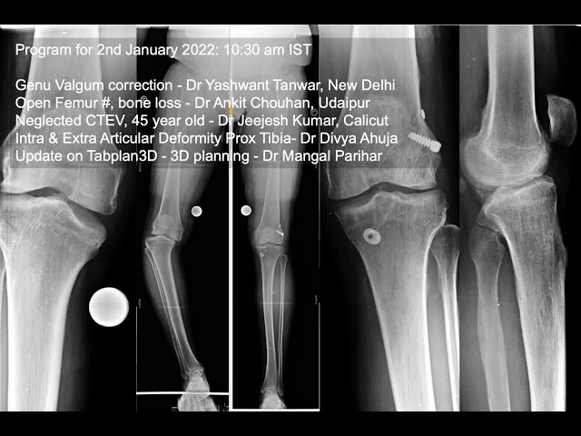 Ilizarov Case Discussion: (January 2022) (please see below for direct links to various cases)