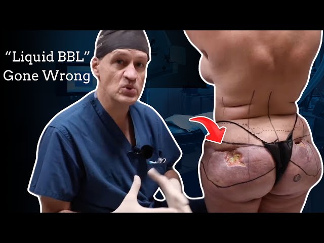 Buttock Amputation to Remove Illegal Butt Shots - Silicone Removal Surgery (Permanent Filler)