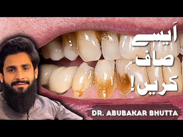 Top #1 Method to remove DENTAL PLAQUE | دانتوں کی صفائی ایسے کریں