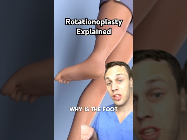 Why is the foot on backwards? This is called a rotationplasty.