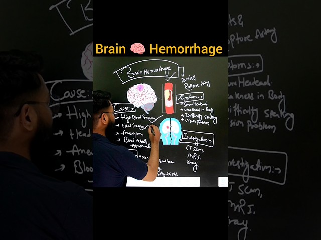 Brain 🧠 Hemorrhage🩸💉 #brain #hemorrhage #medical #radiology #science #shorts  #shortfeed #love