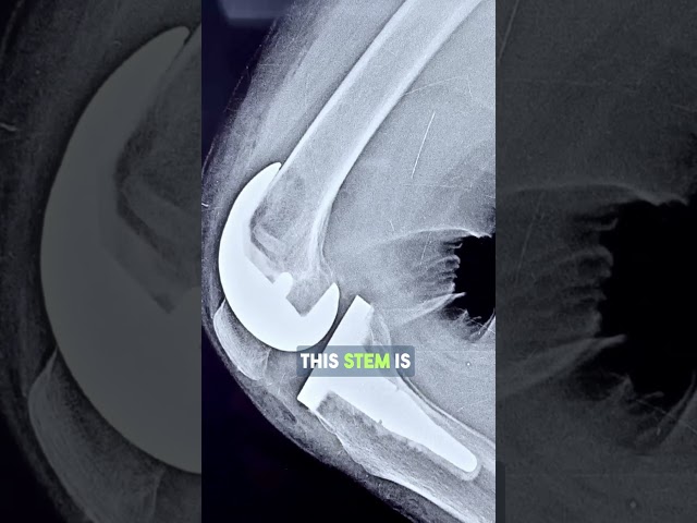 WHY DO I HAVE BRUISES AFTER A KNEE REPLACEMENT? # #drpankajwalecha #kneesurgery