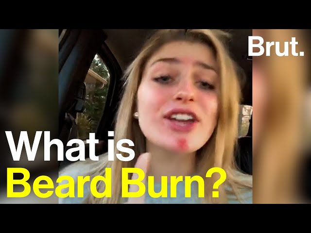 What is "Beard Burn?"