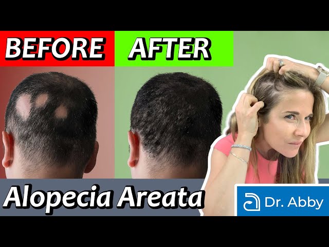 Alopecia Areata: Causes and Treatment from a Dermatologist