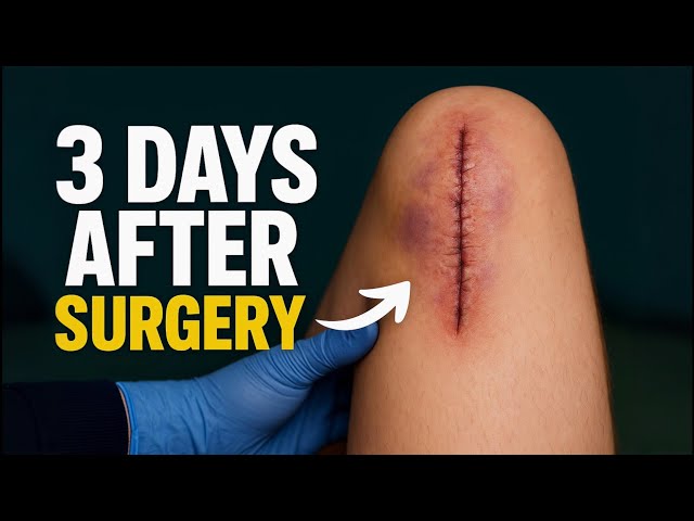 How to Recover After Knee Surgery: Real Patient Progress