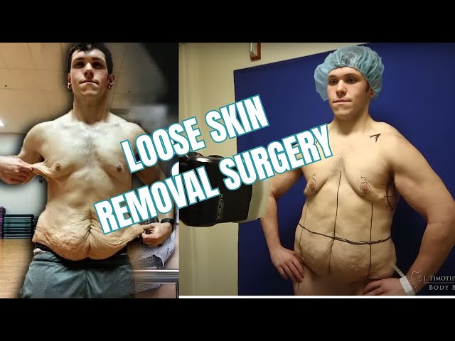 Zach Attacks Fat Skin Removal Surgery After Massive Weight Loss