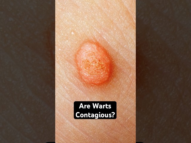 Are Warts Contagious? Here’s the Truth