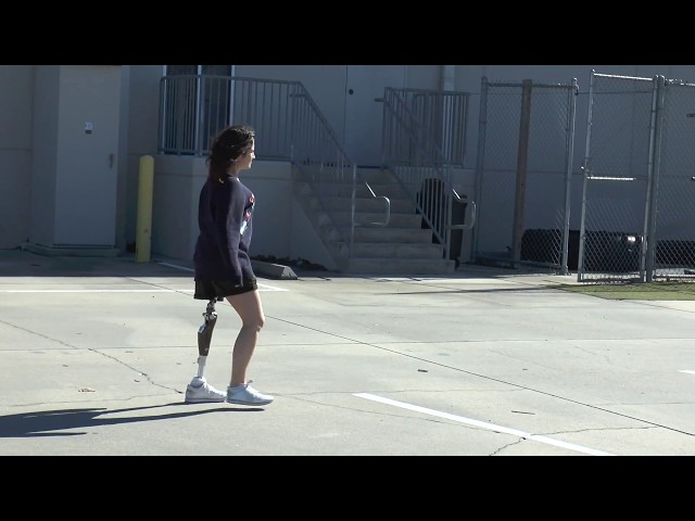 Carolina, Hip Disarticulate Amputee, Walks for First Time