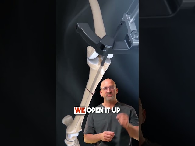 Tibia Fracture Hammer & Nail 🔨 #shorts