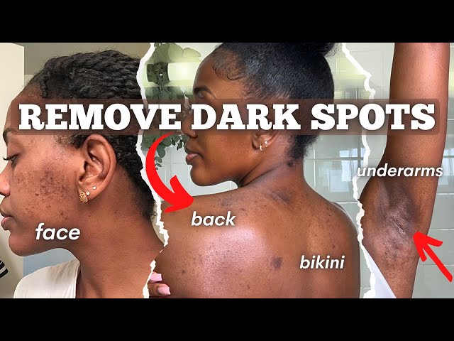 HOW TO CLEAR FULL BODY HYPERPIGMENTATION AND ACNE | Face, Underarms, Bikini, Back | SKIN ROUTINE