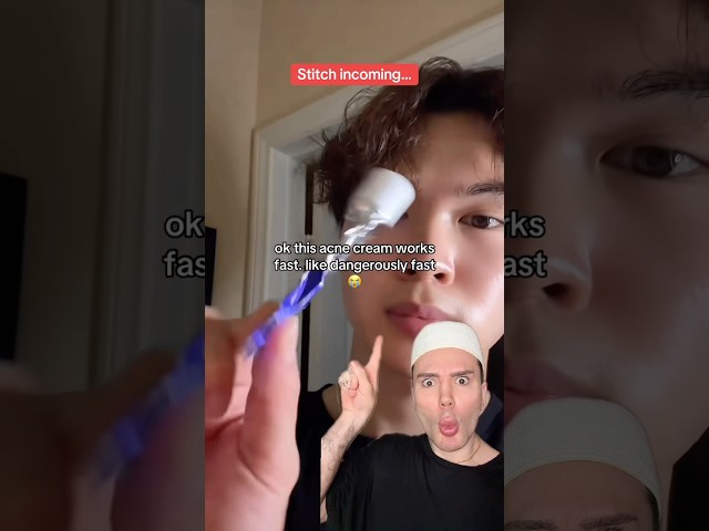 VIRAL ACNE CREAM!😱 #acne #acnetreatment #pimple #pimples #skincaretips