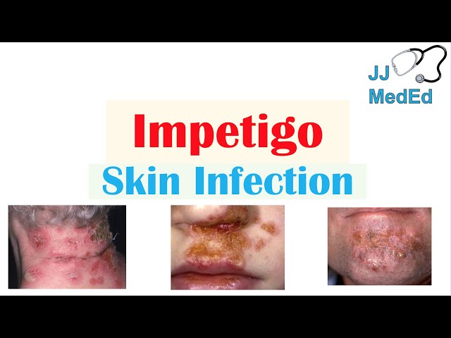 Introduction to Impetigo | Infection, Subtypes and Treatment