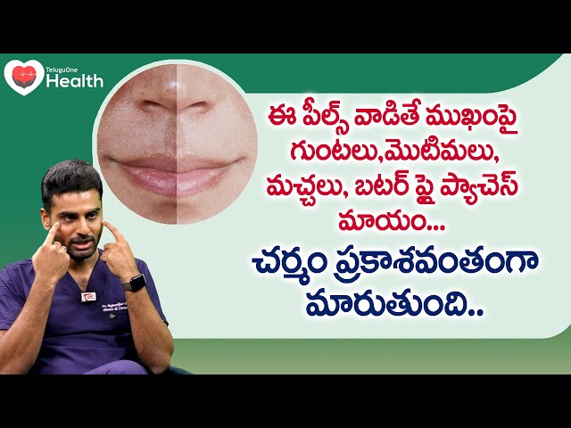 Chemical Peels | ముఖంపై గుంటలు, మొటిమలు, బటర్ ఫ్లై ప్యాచెస్ మాయం Dr. Rajasekhar Madala | Tone Health