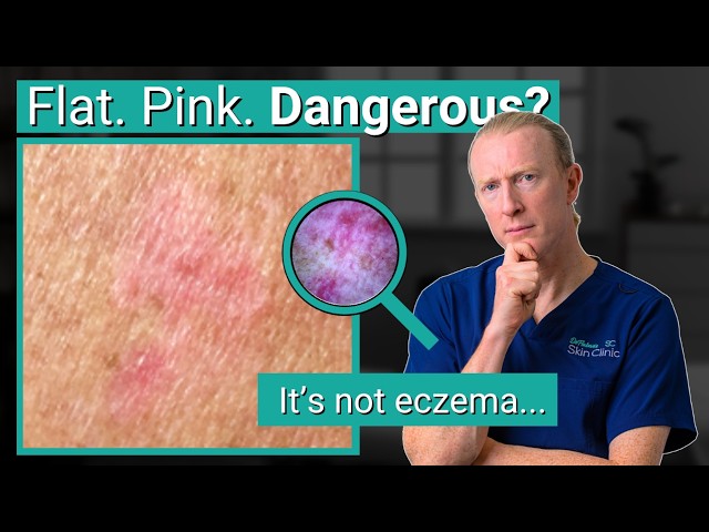 That Red Patch Might Be Skin Cancer | What Is Superficial BCC?