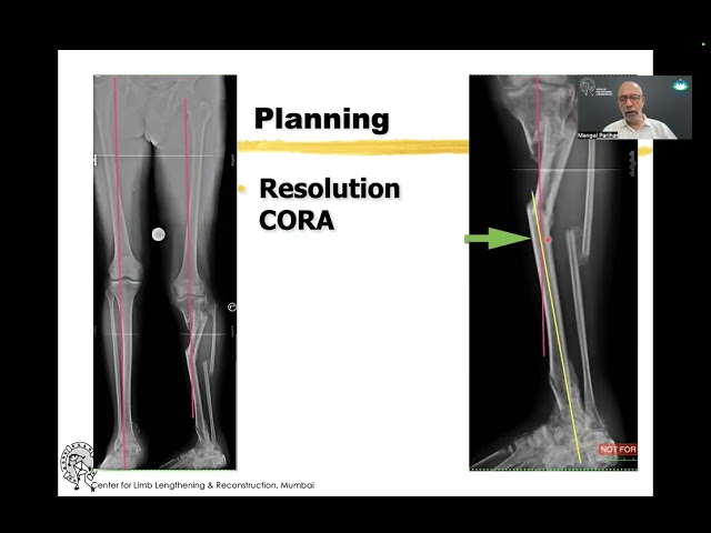 Six Axis systems for deformity correction
