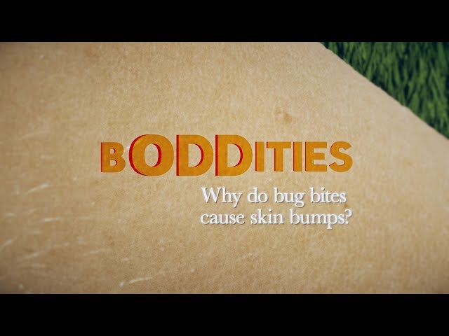Boddities | Episode 11 | Why do bug bites cause bumps on the skin?