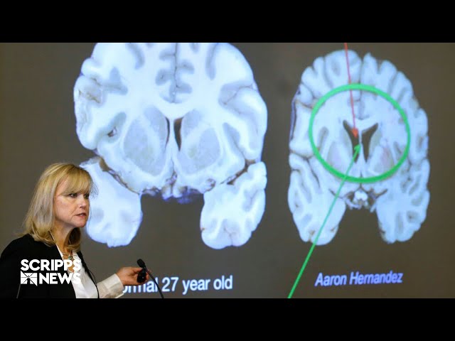 CTE Risk Unveiled Beyond Concussions in Football | New Harvard Study