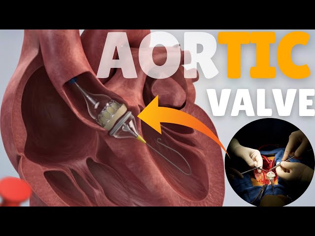 How Aortic Valve Replacement (AVR) Surgery Works? | 3D Animation | Open Heart Surgery step by step 