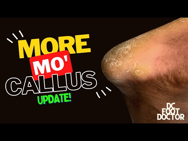More Mo' Callus