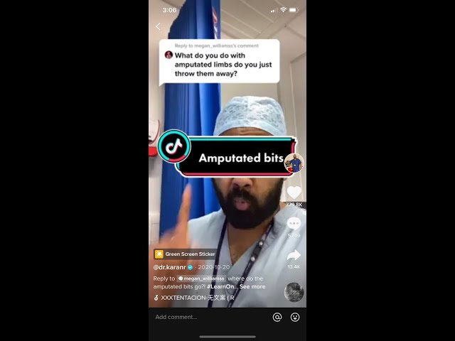 Doctor reacts to What happens to amputated limbs after surgery? #shorts