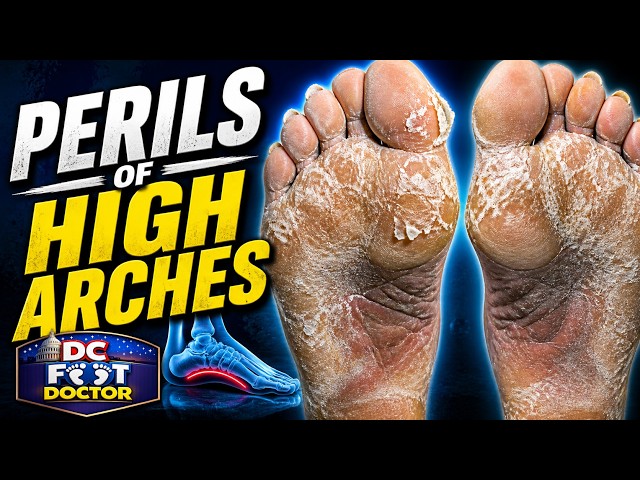 Perils of High Arches