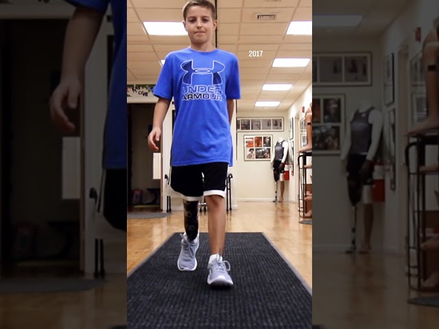 Below-Knee Amputee Gino Walking with His Custom Prosthetic Leg | From Childhood to College