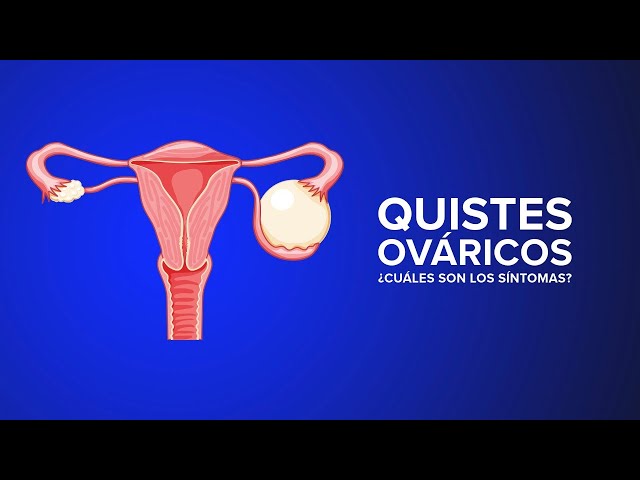 Quistes de ovario: ¿Cuáles son los síntomas?