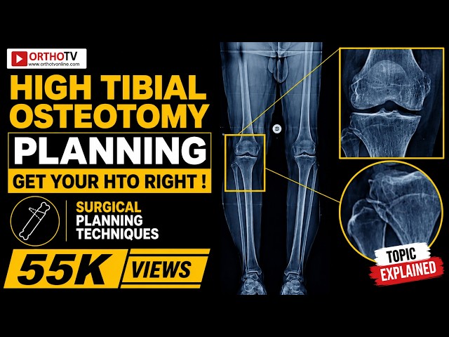 High tibial osteotomy planning - Get your HTO right ! : Dr Clement Joseph