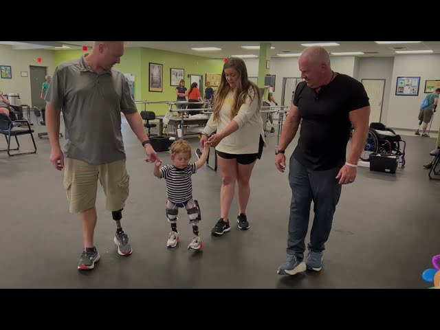 Louie, Bilateral Above Knee PPS Socket Congenital Amputee