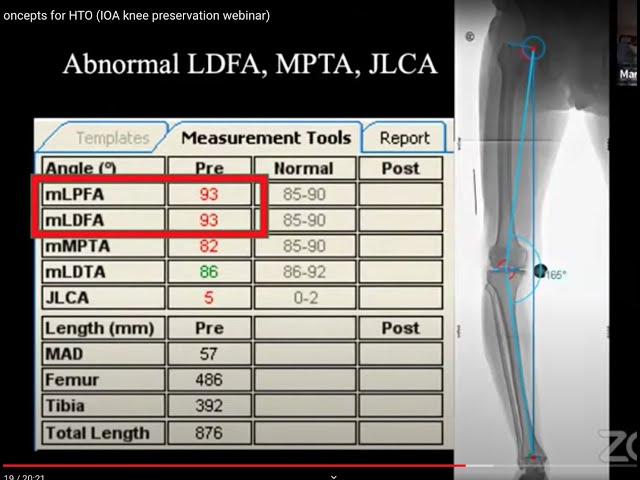 Basic Deformity Concepts for HTO (IOA knee preservation webinar)