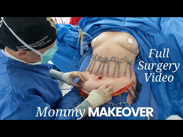 60 y/o Mommy Makeover (Tummy Tuck & Breast Lift)