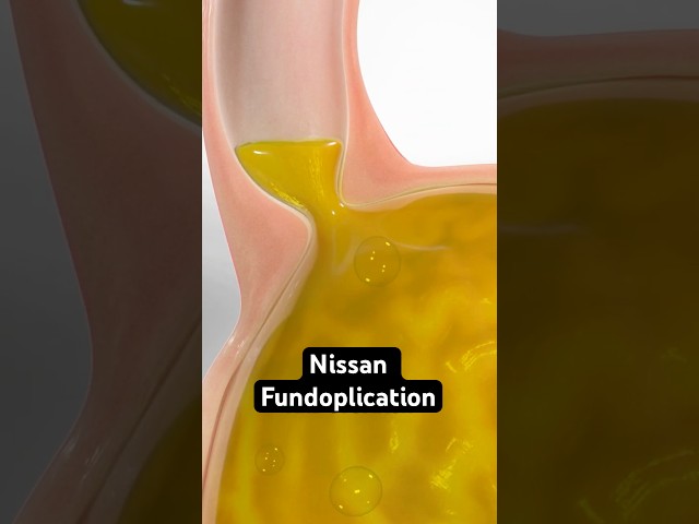 How Doctors Stop Heartburn for Good
