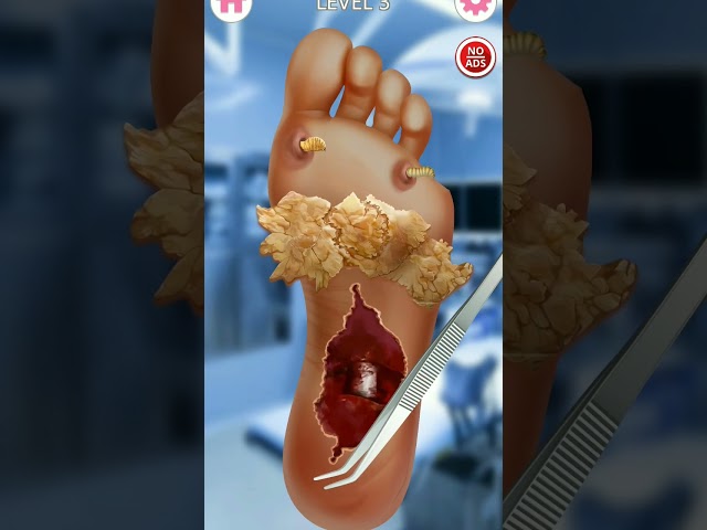 foot treatment 😮💥 #shorts #treatment #games #asmr