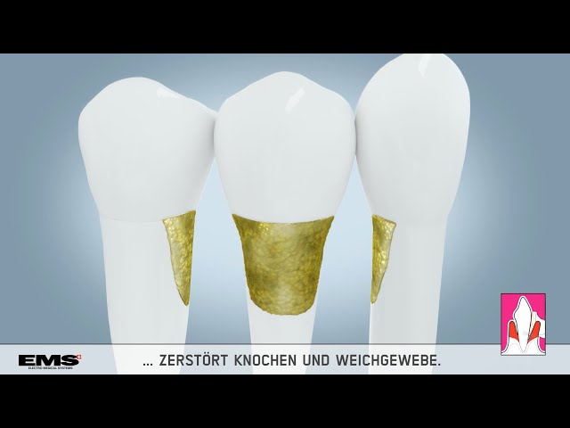 Professionelle Zahnreinigung mit Air Flow (3D Animation)