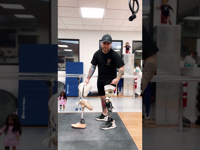 Van Nes Rotationplasty Patients Find True Mobility with the Proper Fit at A Step Ahead Prosthetics