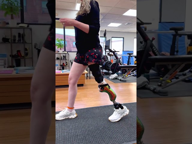 Prosthetic Training and Progress After Van Nes Rotationplasty | Sydney