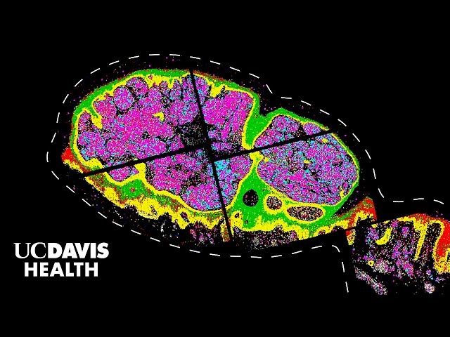 New Genetic Clues About Melanoma Revealed Through Powerful Imaging | UC Davis Health Research