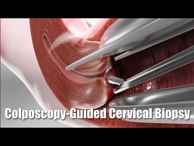 Sampling abnormal cervical tissue for cancer