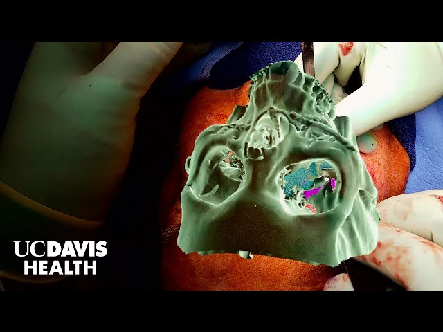 Mixed Reality Goggles Guide Complex Surgeries |  UC Davis Health Research